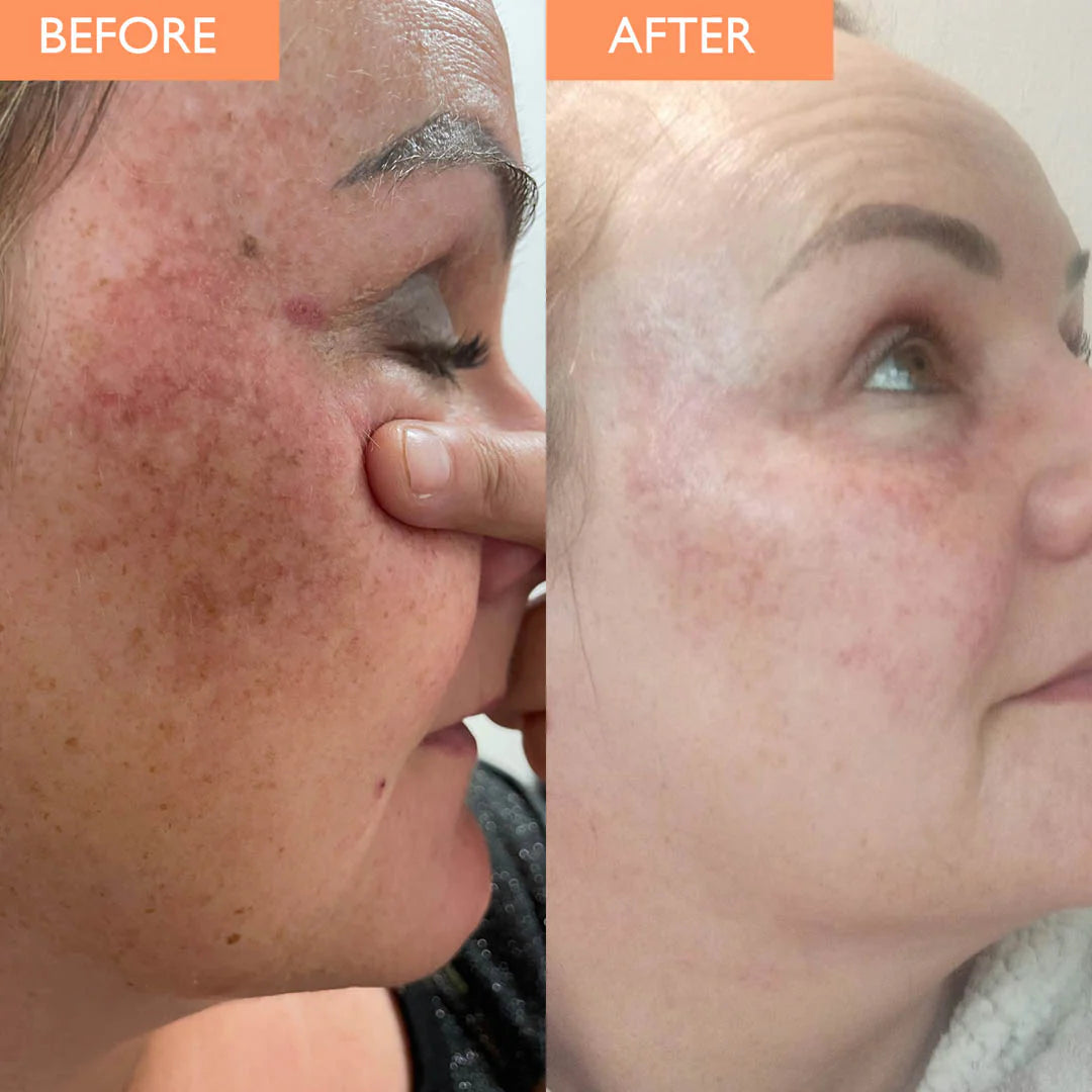 Black Friday : SOLIQ ™ Tumeric Kojic&  Acid Soap