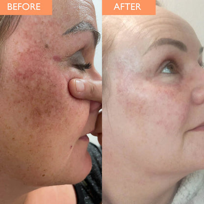 Black Friday : SOLIQ ™ Tumeric Kojic&  Acid Soap