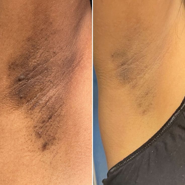 Black Friday : SOLIQ ™ Tumeric Kojic&  Acid Soap