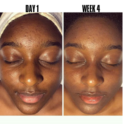 Black Friday : SOLIQ ™ Tumeric Kojic&  Acid Soap