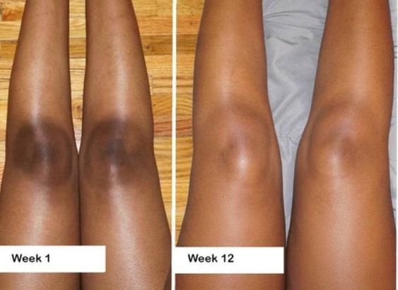 Black Friday : SOLIQ ™ Tumeric Kojic&  Acid Soap